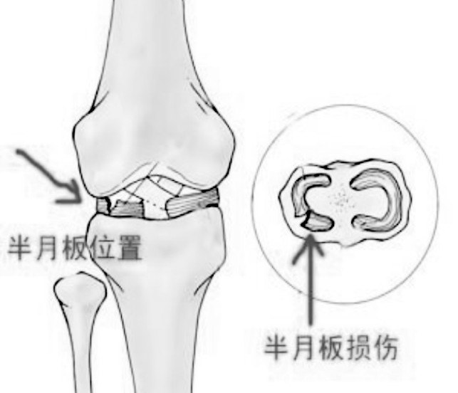 半月板治療新進(jìn)展揭秘，巷弄深處的醫(yī)學(xué)奧秘探索